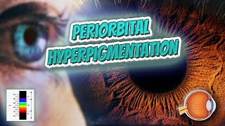 Periorbital hyperpigmentation  Your EYEBALLS  EYNTK 👁️👁️💉😳💊🔊💯✅ [upl. by Halbeib]