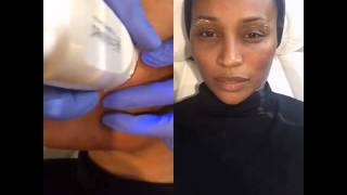 EndyMed RF Micro Needling with RHOAs Cynthia Bailey at Ederra Bella [upl. by Anasxor]