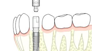 Ankylos™ – surgical and prosthetic procedure  Dentsply Sirona [upl. by Akili]