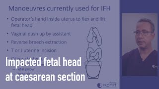 Impacted fetal head at caesarean section [upl. by Lauretta383]