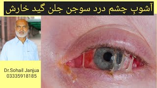 EYE INFECTION  VIRAL EYE FLUE  أشوبِ چشم  HOMOEO MEDICINE [upl. by Naesal]