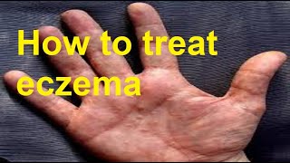 How to treat eczema [upl. by Bryce43]