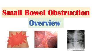 Small Bowel Obstruction SBO  Risk Factors Causes Signs amp Symptoms Diagnosis Treatment [upl. by Arakahs]