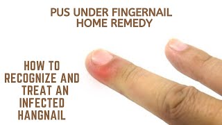 Pus under fingernail home remedy  How to Recognize and Treat an Infected Hangnail [upl. by Mattie89]