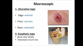 Squamous cell carcinoma SCC [upl. by Laud82]