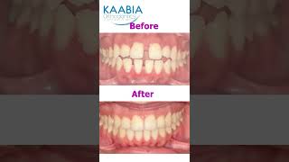 Bimaxillary protrusion  open bite and diastema [upl. by Yejus]