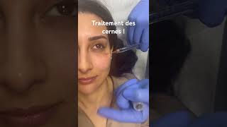 Traitement des cernes par acidehyaluronique raspaldo regard medecineesthetique [upl. by Reema]