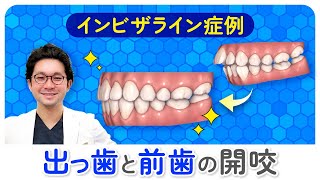 【インビザライン経過症例５】マウスピース矯正 出っ歯と開咬（非抜歯） 矯正専門歯科医師が解説 [upl. by Lois]