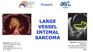 LARGE VESSEL INTIMAL SARCOMA [upl. by Crescin646]