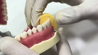 Anterior all ceramic crown preparation [upl. by Oirrad]