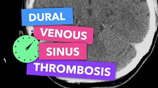 Dural venous sinus thrombosis  Radiopaedias Emergency Radiology Course [upl. by Haodnanehs]