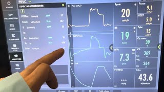 How to check Plateau Pressure PPlat on a ventilator before and during Critical Care Transport [upl. by Atika]