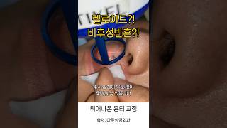 켈로이드 비후성반흔 튀어나온 흉터 주사 레이져 레이저 병원 keloid hypertrophic scar laser injection seoul korea아문TV [upl. by Naujit987]