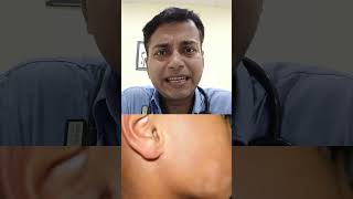 Pityriasis Alba For Consultation please call on 7400124238 shortvideo motivation [upl. by Corenda]