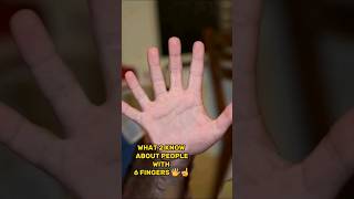 WHAT TO KNOW ABOUT PEOPLE WITH 6 FINGERS🖐️☝️ [upl. by Lotte]