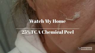 Home Tca Peel 25 Skin Obsession [upl. by Neelyaj]