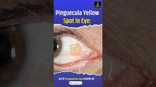 Pinguecula Yellow Spot in Eye Pinguecula eye testpaperlive [upl. by Inaej]