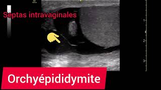 Orchyépididymite Échographie Hydrocèle Septas Epididymoorchitis [upl. by Atsyrk]