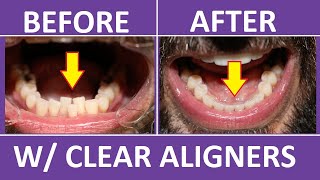 Invisalign Braces Before and After Overbite Crowding Teeth Cost Pain Tips 3M Clear Aligners [upl. by Amye]