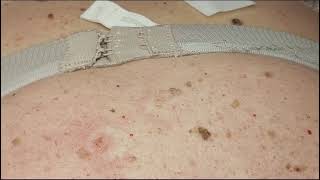 441 Seborrheic Keratosis Removal on Back Janine giving training [upl. by Fernandes863]