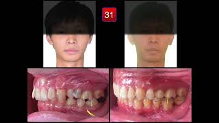 Ankylosis Case Analysis｜【Chris Chang Ortho】CC775 [upl. by Zoarah]