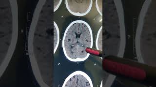 INTRACRANIAL CALCIFICATION doctor hospital  shorts video [upl. by Buxton341]