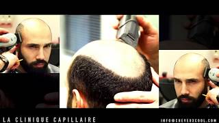 La Greffe de Cheveux Non Chirurgicale  La Clinique Capillaire  CheveuxCoolcom [upl. by Annahc]