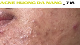 Acne Treatment Huong Da Nang 718  Remove Blackheads [upl. by Dupre]