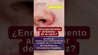 ¿Enrojecimiento alrededor de la nariz varices [upl. by Keynes]