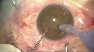 Cataract surgery  Quick Chop [upl. by Hukill]