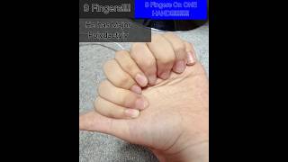 Major polydactyly 9 fingers on one hand [upl. by Nnaear237]