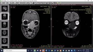 Left nasal cavity Ossifying Fibroma  Endoscopic excision  Dr Satish Jain [upl. by Dirfliw]