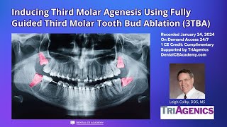 Free Dental CE Webinar INDUCING THIRD MOLAR AGENESIS USING FULLY GUIDED TOOTH BUD ABLATION 3TBA [upl. by Aker]