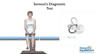 Semont Maneuver A Step by Step Guide to Treat BPPV Vertigo [upl. by Allerym]