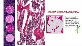 Capitulo 6 tejido sanguineo Aplasia medular [upl. by Eelrahc]