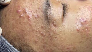 ACNE TREATMENT VU QUYNH MI  Perennial Blackheads On Boy Face 2024FULL [upl. by Otipaga]