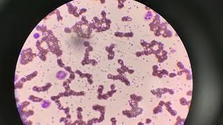 Abnormal platelet count  Thrombocytosis 100x [upl. by Doerrer]