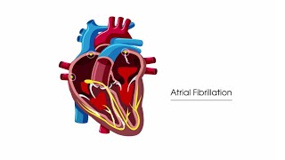 What is atrial fibrillation [upl. by Valentia]