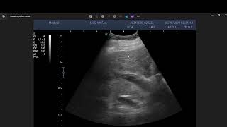 Portal vein malignant thrombus [upl. by Scrivens]