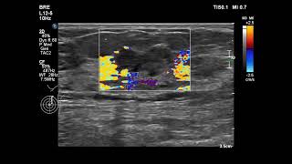 invasive ductal carcinoma [upl. by Enilreug]