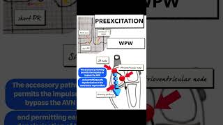 Overview of WolffParkinsonWhite WPW Syndrome [upl. by Etnoid]