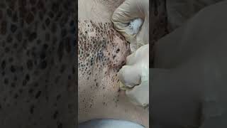 Nevus Comedonicus removal [upl. by Halfdan]