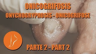 Onicogrifosis 2da parte podologiaintegral [upl. by Enomrej]