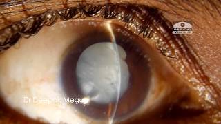 Traumatic Cataract with ruptured anterior capsule Secondary Glaucoma Dr Deepak Megur [upl. by Naam]