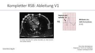 FokusEKG Blickdiagnosen Rechtsschenkelblock [upl. by Dorran205]