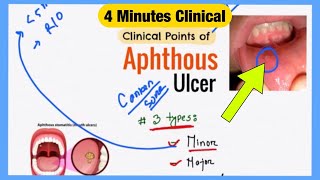 Aphthous Ulcer Explained Like Water  Symptoms Pathophysiology Treatment  Bengali Medicine Lecture [upl. by Arretak78]