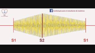 Soplo de la persistencia del conducto arterioso [upl. by Annavaig]