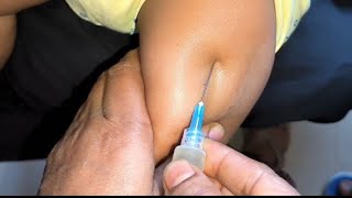 Arms injection video Intramuscular Ceftriaxone 500mg Exephin injection push24 P28 by cannula 69 [upl. by Kannan900]