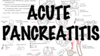 Acute Pancreatitis  Overview signs and symptoms pathophysiology investigations treatment [upl. by Lledualc87]