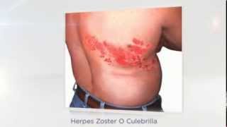 tratamiento para el herpes zoster [upl. by Immac]